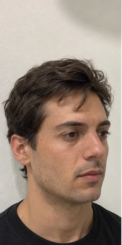 Armonización facial, antes