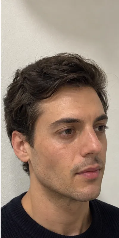 Armonización facial, después