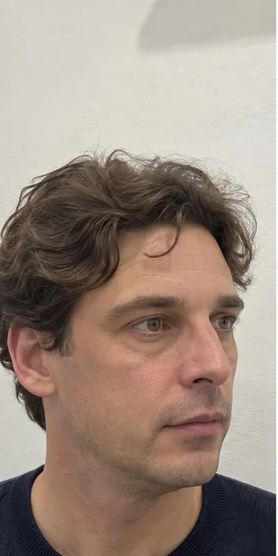 Armonización facial, antes