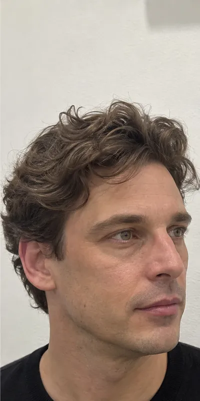 Armonización facial, después