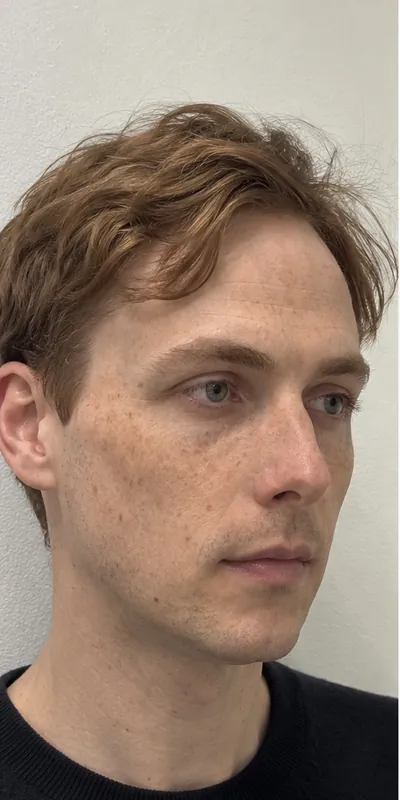 Armonización facial, antes