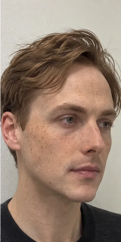 Armonización facial, después