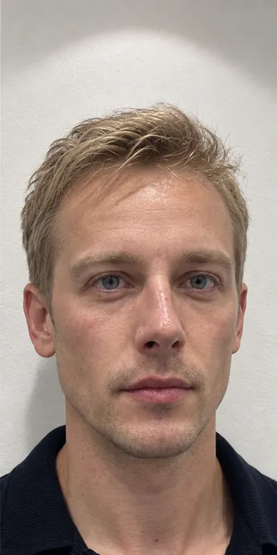 Armonización facial, después