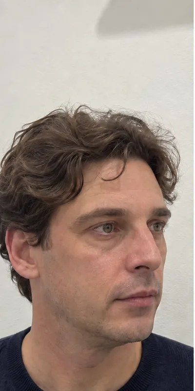 Armonización facial, antes