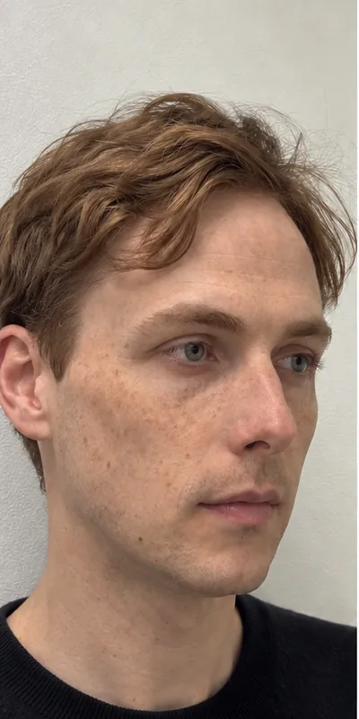 Armonización facial, antes