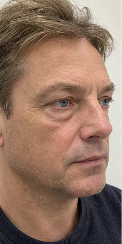 Blefaroplastia, antes