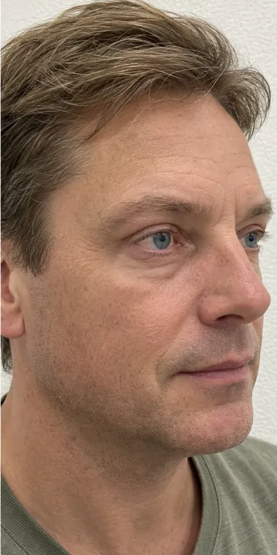 Blefaroplastia, después