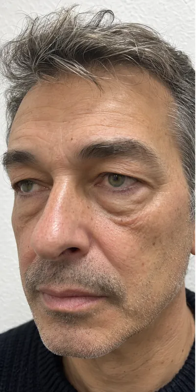 Blefaroplastia, antes