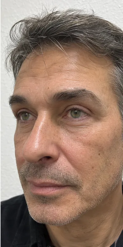 Blefaroplastia, después