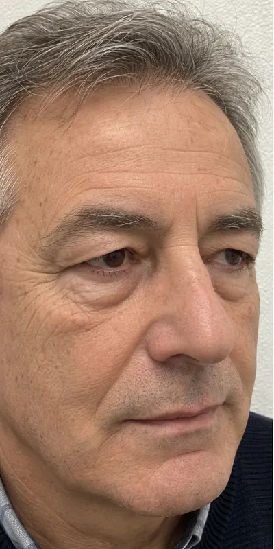 Blefaroplastia, antes