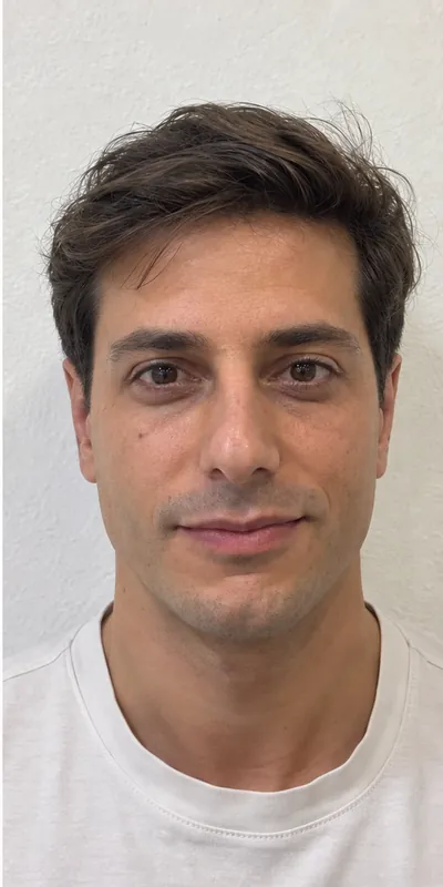 Otoplastia, después