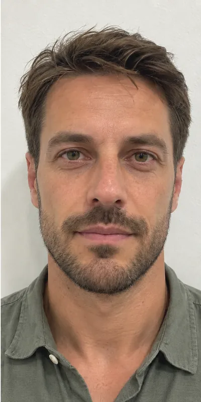 Otoplastia, después