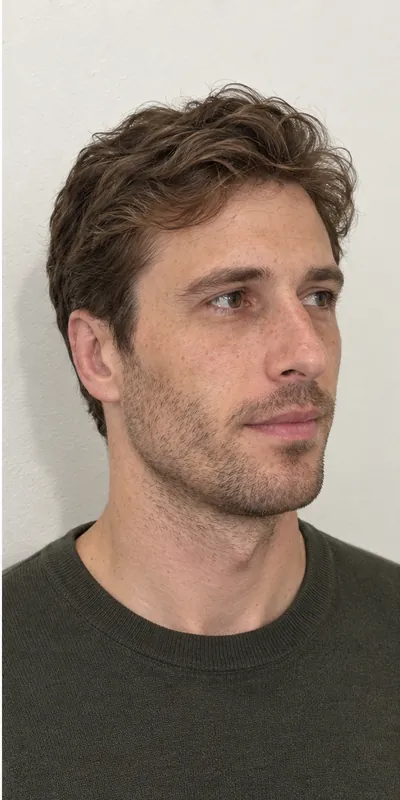 Otoplastia, después