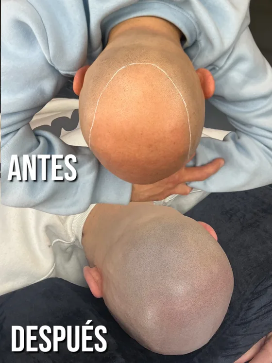 Efecto rapado, antes y después