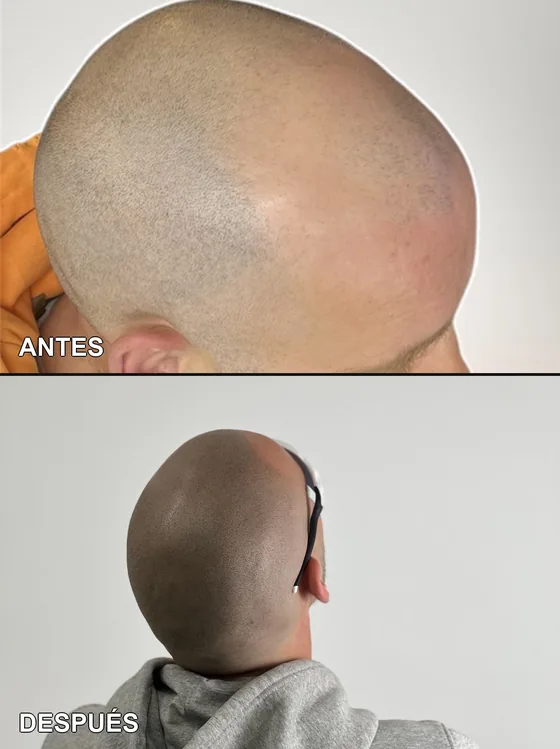 Efecto rapado, antes y después