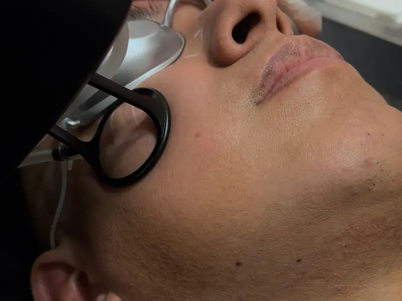 Solució per a cicatrius i marques de l'acne